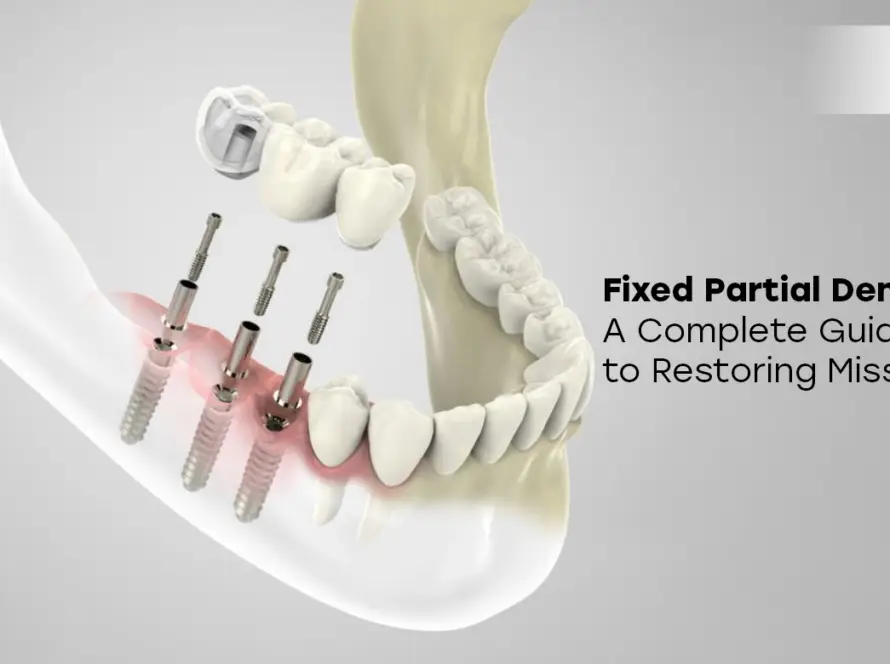 Fixed Partial Dentures