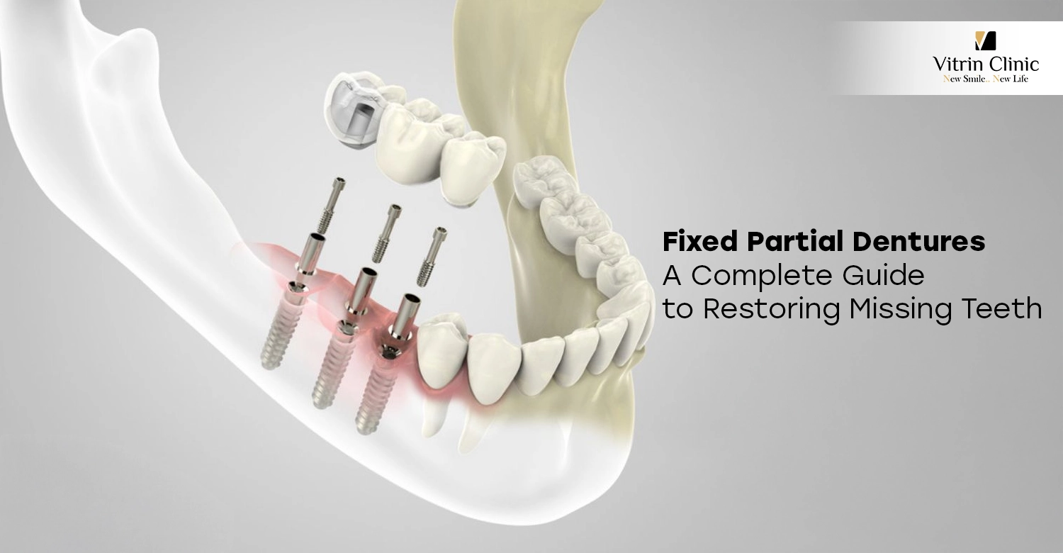 Fixed Partial Dentures