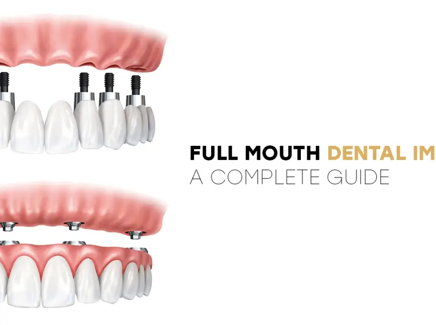 Full Mouth Dental Implants