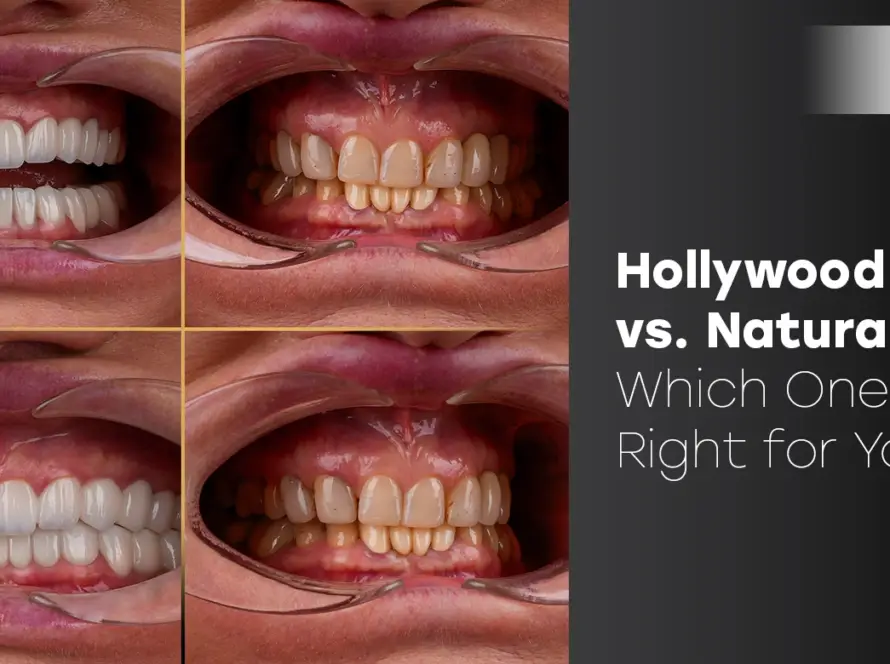 Hollywood Smile vs. Natural Smile