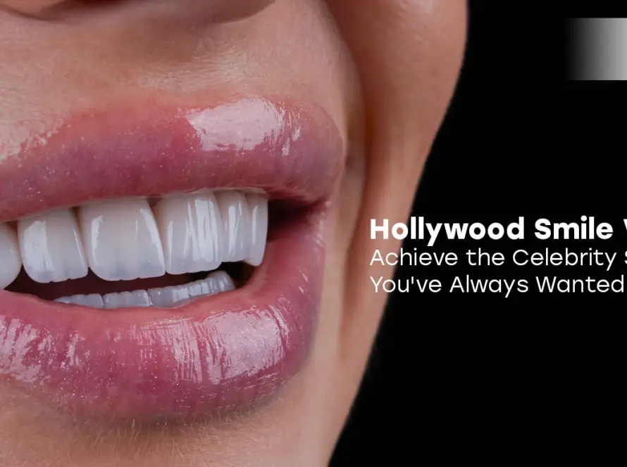 Hollywood smile veneers
