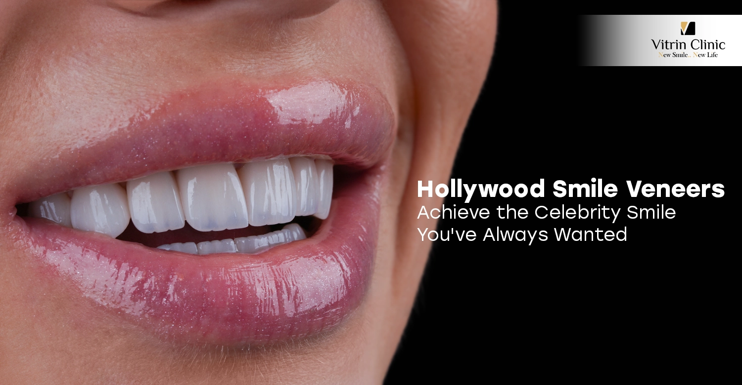 Hollywood smile veneers