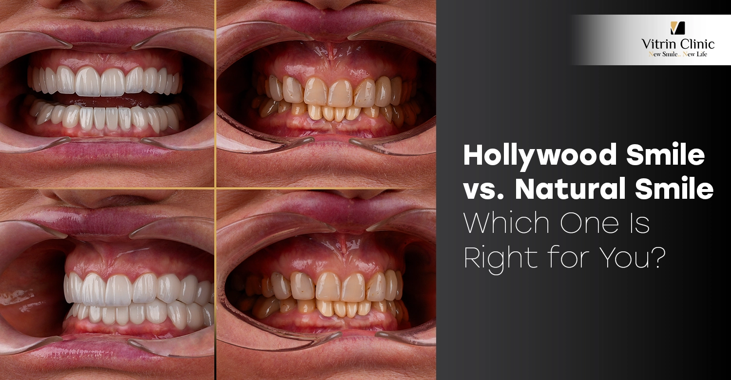Hollywood Smile vs. Natural Smile