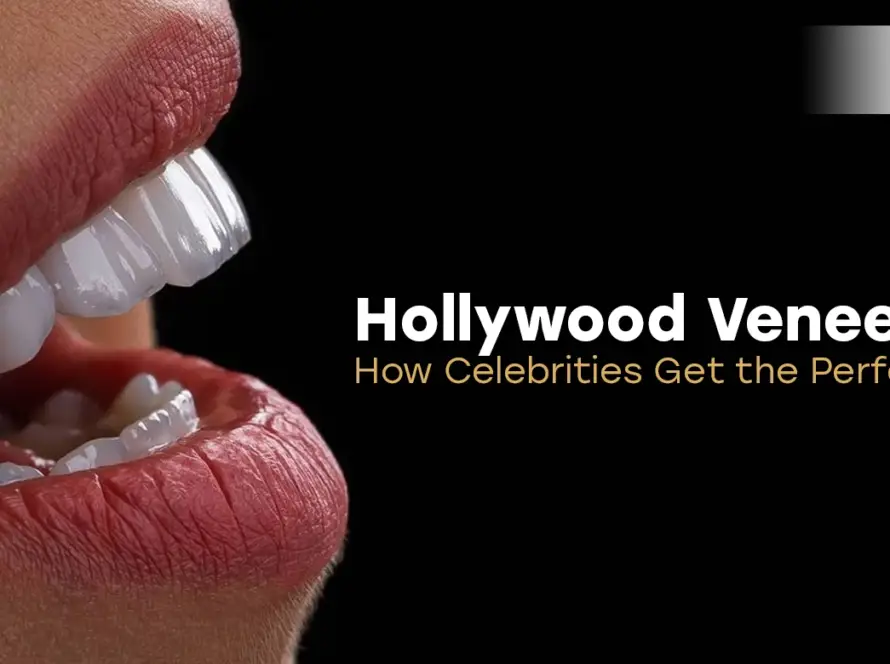 Hollywood veneers