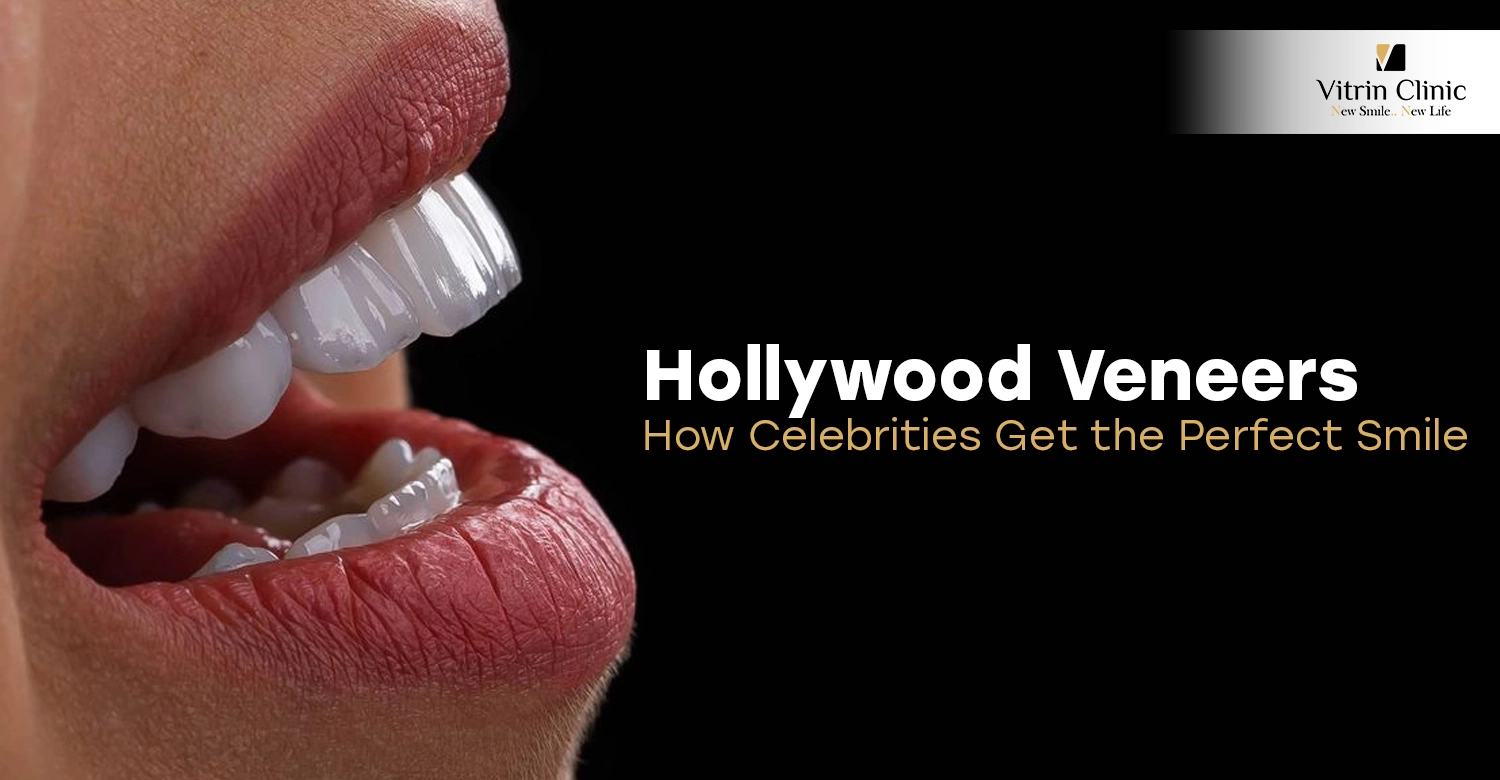 Hollywood veneers
