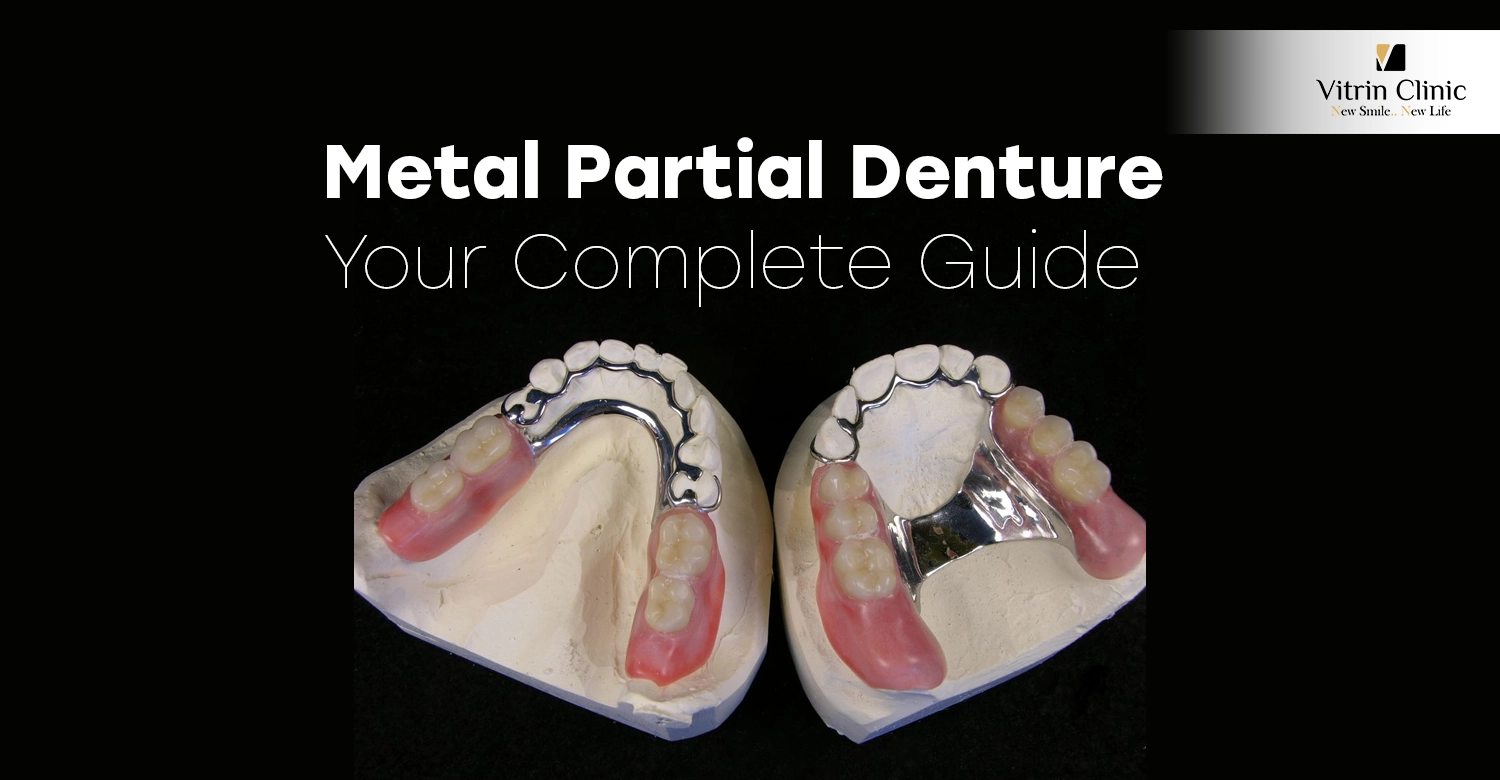 Metal Partial Denture