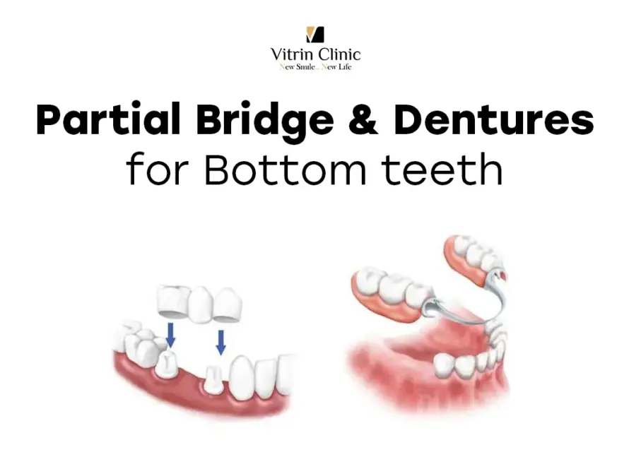 bridge lower partial dentures bottom front teeth