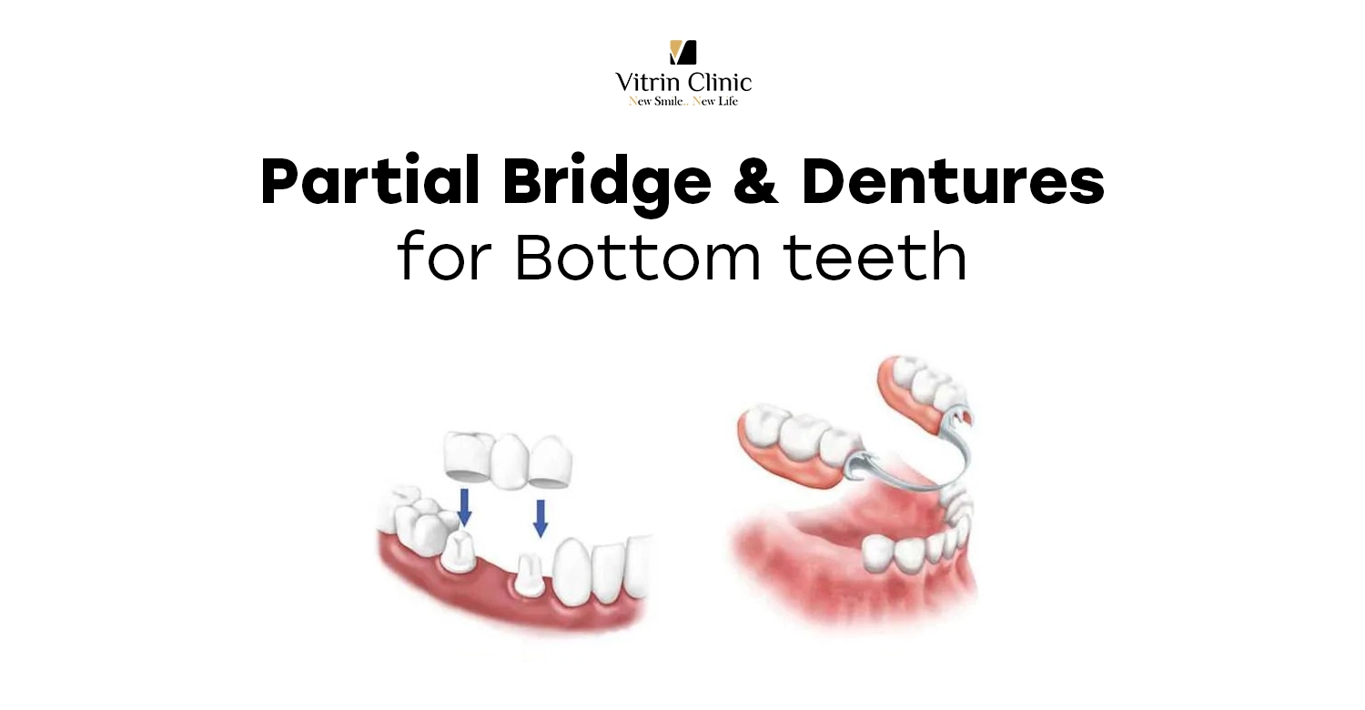 bridge lower partial dentures bottom front teeth