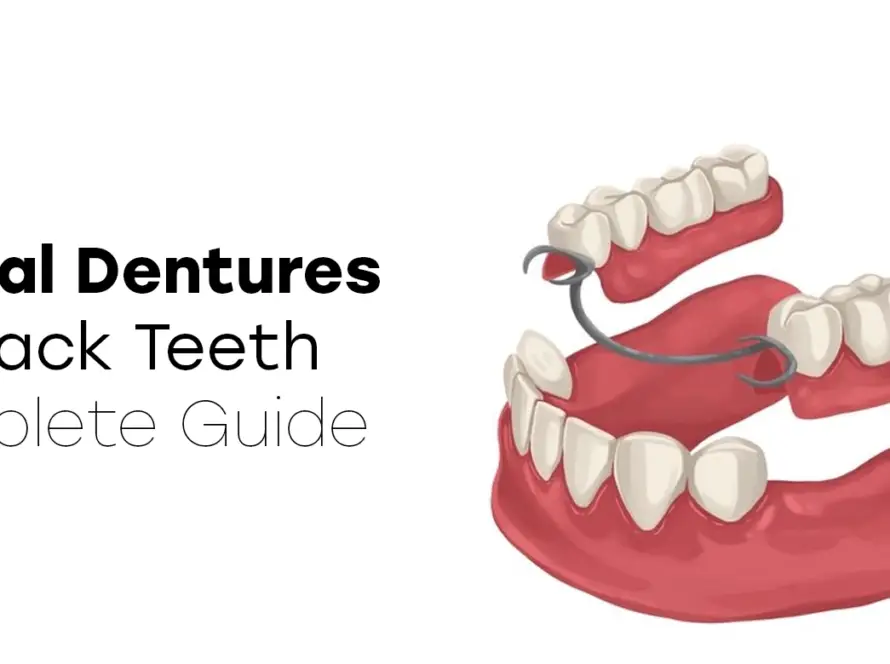 Partial Dentures for Back Teeth