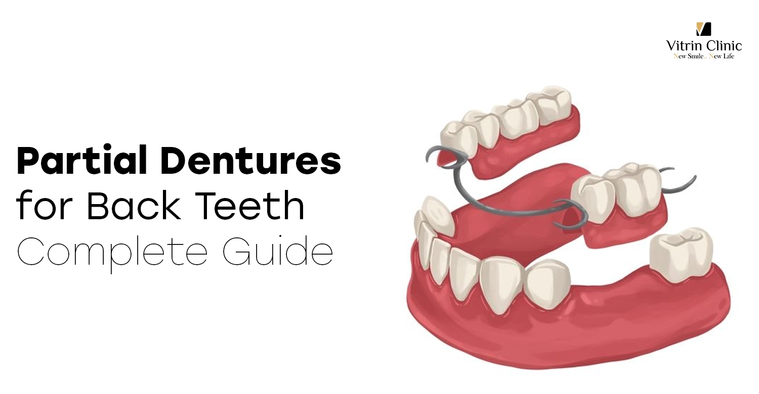 Partial Dentures for Back Teeth