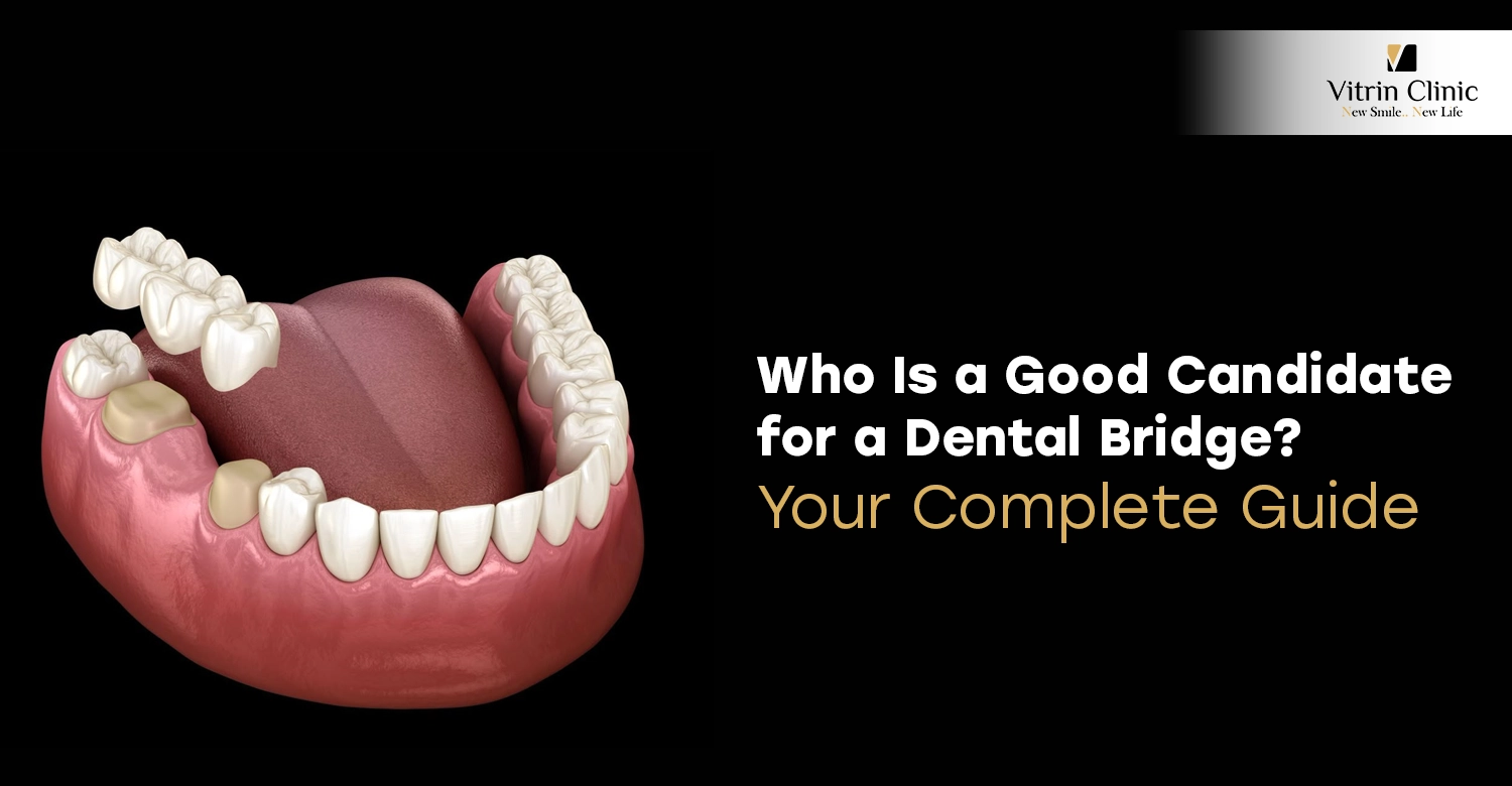 Who Is a Good Candidate for a Dental Bridge