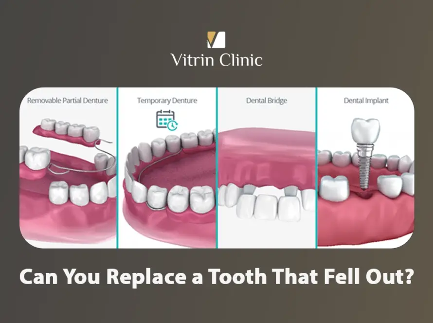 Can you replace a tooth that fell out
