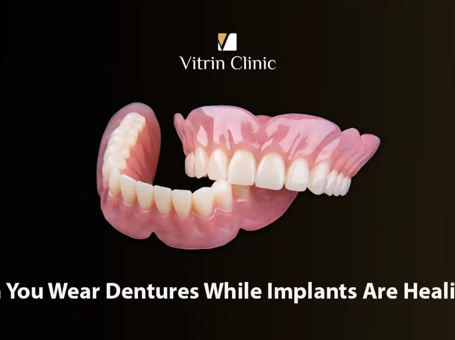 can you wear dentures while implants are healing