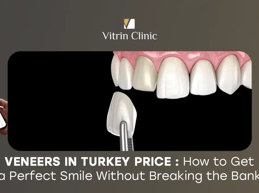 Veneers in Turkey Price:
