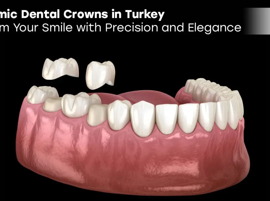 All Ceramic Dental Crowns in Turkey