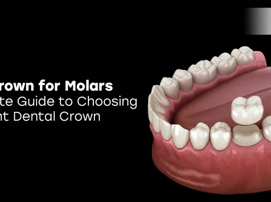 Best Crown for Molars