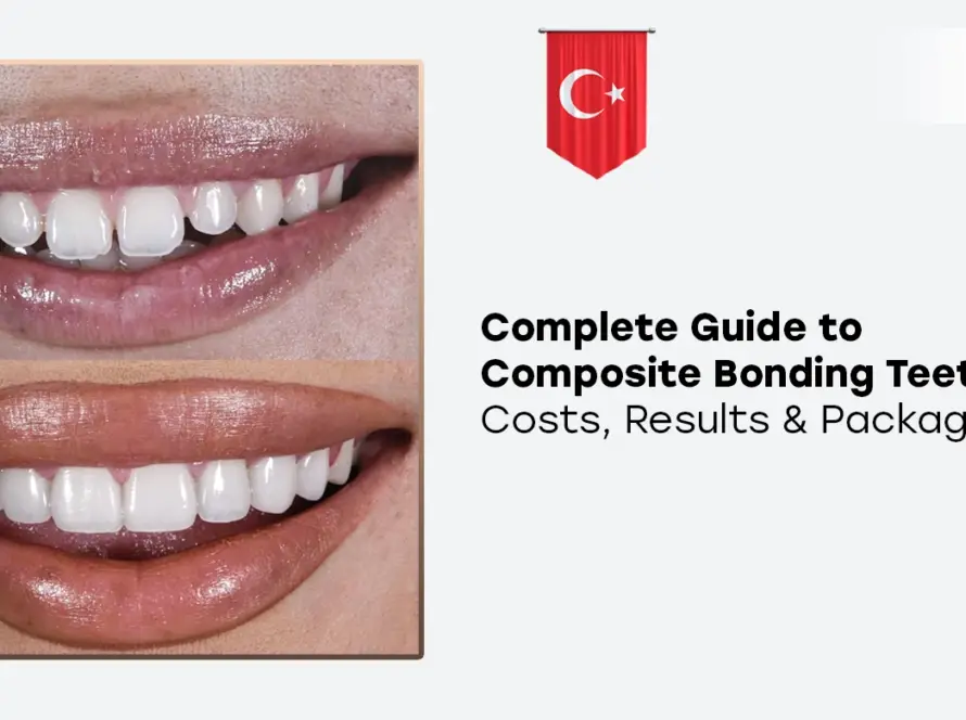 Composite Bonding Teeth Turkey
