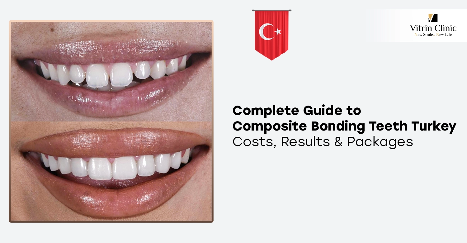 Composite Bonding Teeth Turkey