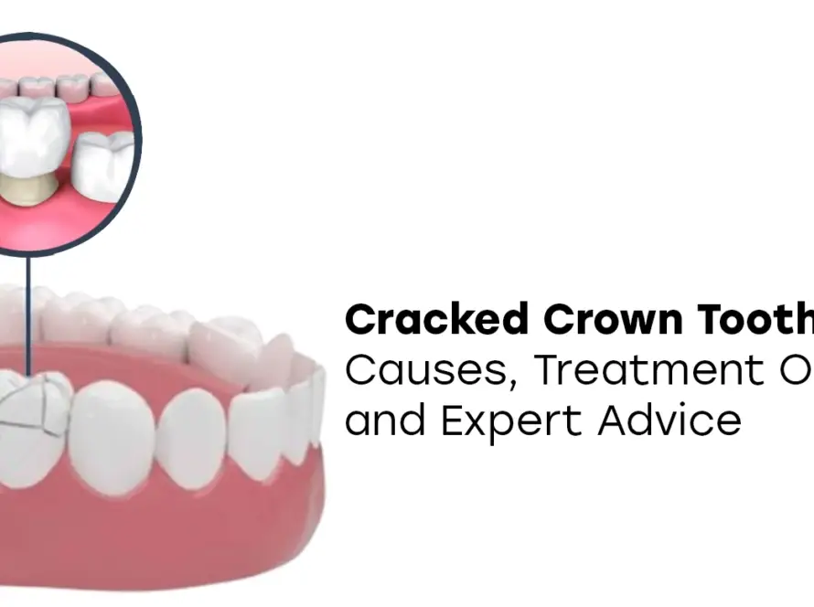 Cracked Crown Tooth