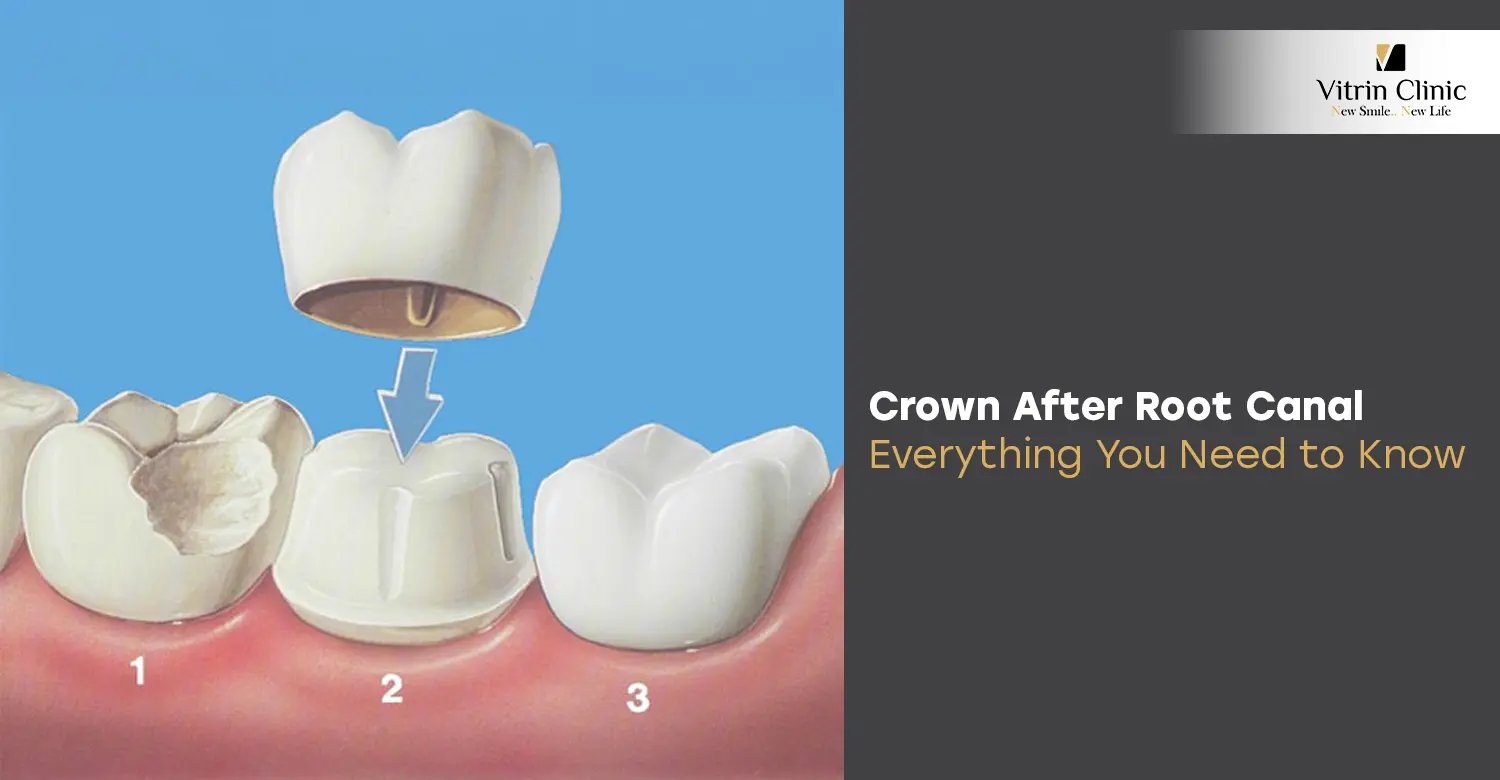 Crown After Root Canal