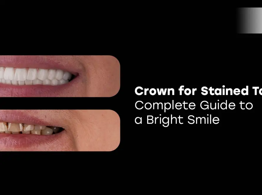 Crown for Stained Tooth
