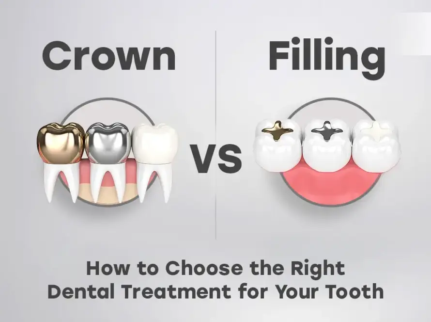 Crown vs Filling