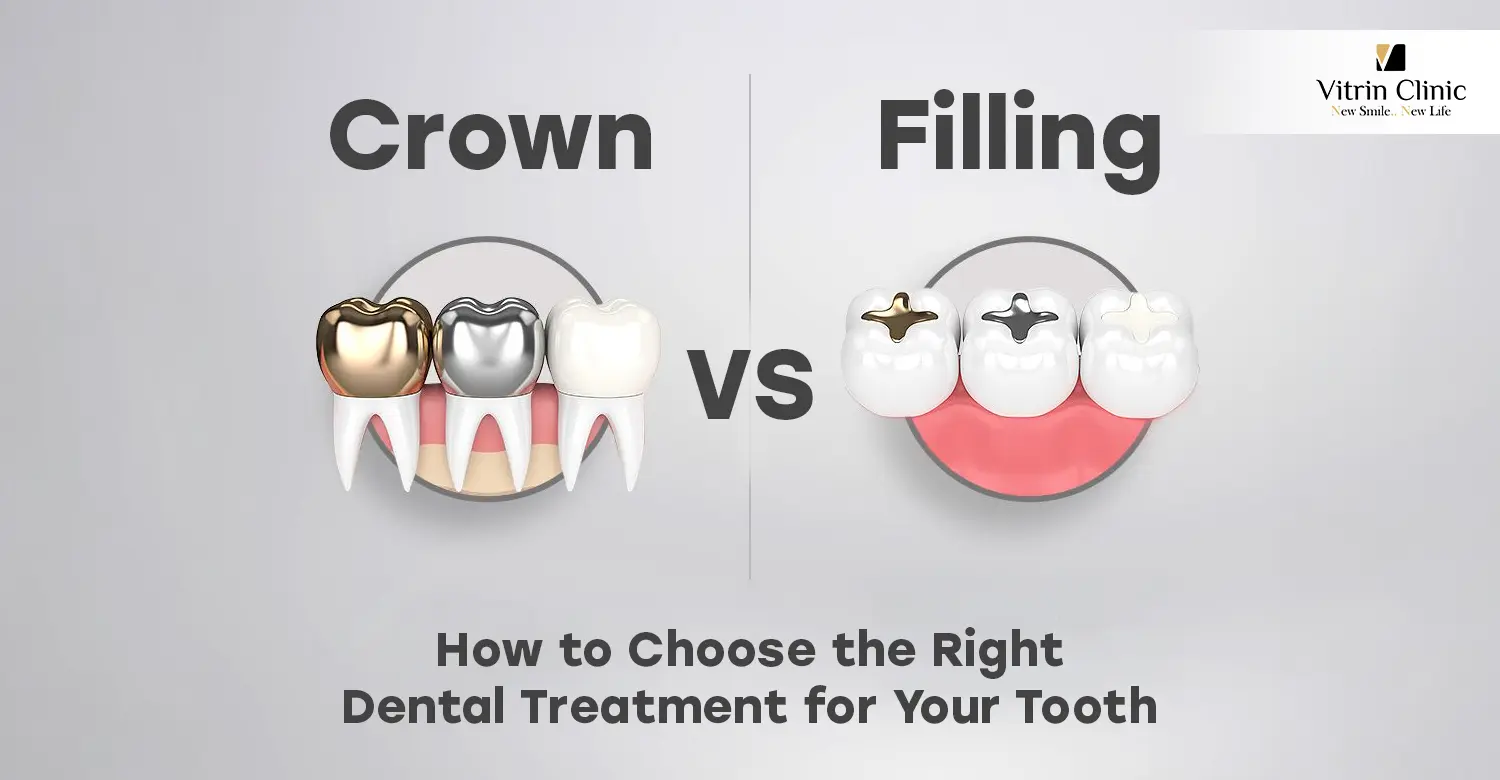 Crown vs Filling