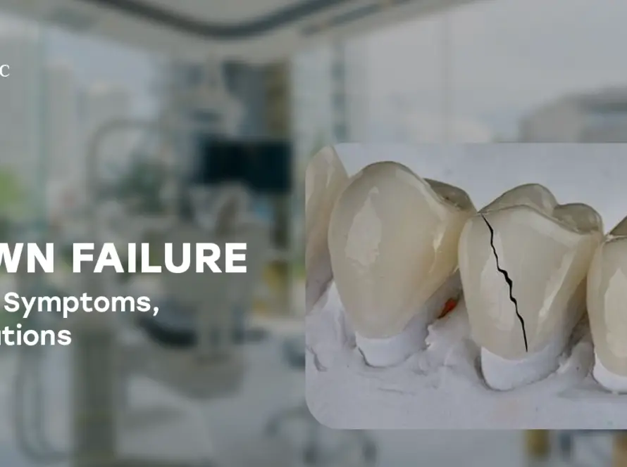 Crown Failure