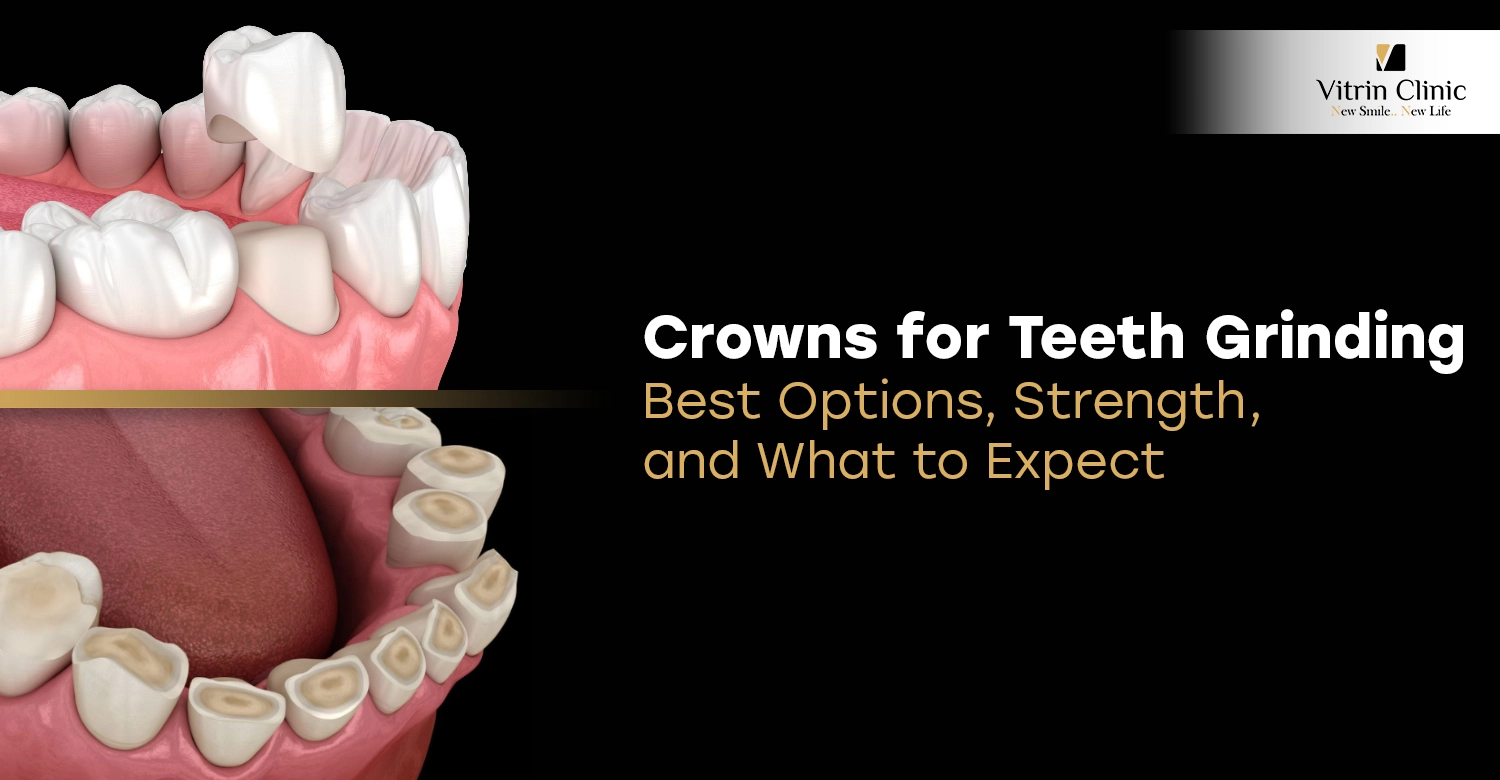Crowns for Teeth Grinding