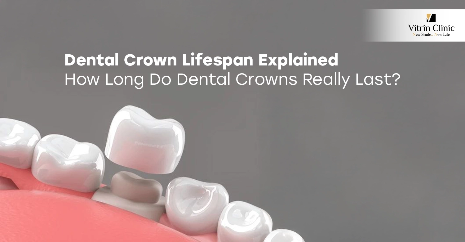 Dental Crown Lifespan Explained