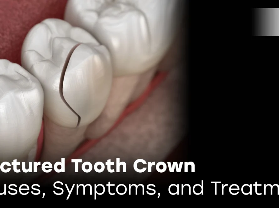 Fractured Tooth Crown