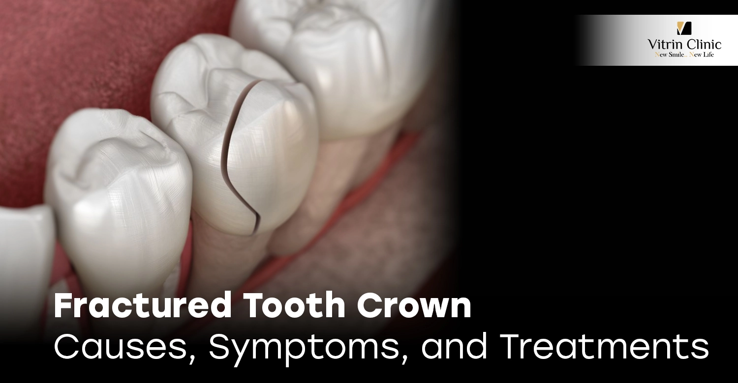 Fractured Tooth Crown