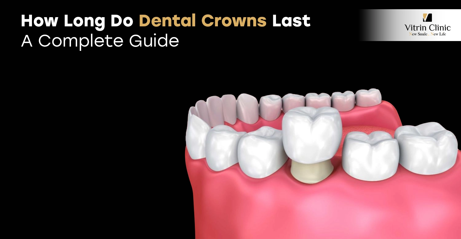 How Long Do Dental Crowns Last