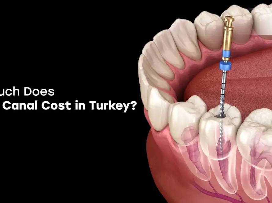 how much does a root canal cost in turkey