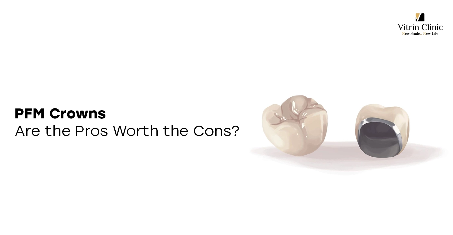 PFM Crowns
