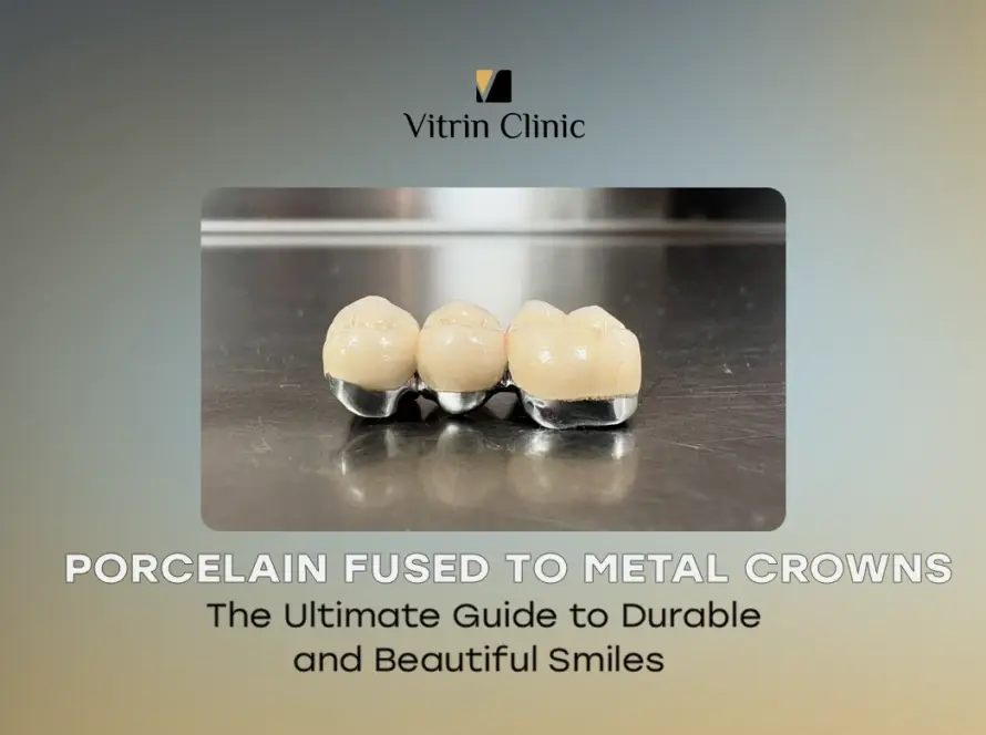 Porcelain Fused to Metal Crowns
