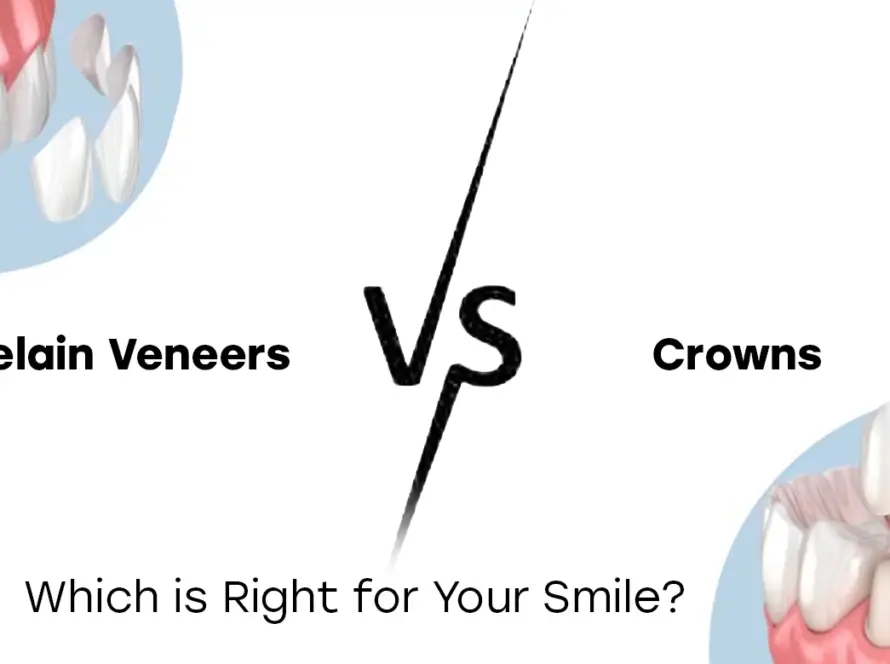 Porcelain Veneers vs Crowns