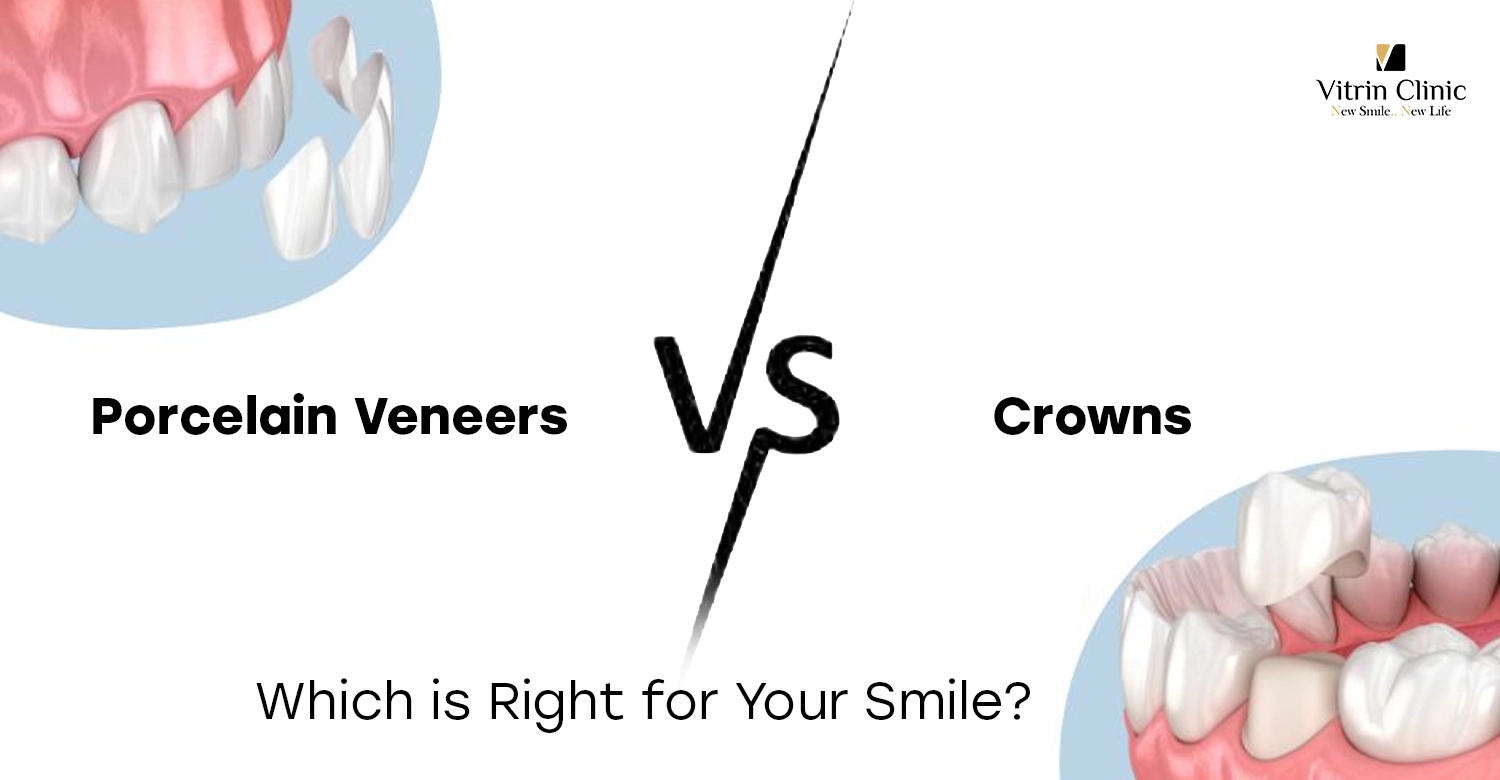 Porcelain Veneers vs Crowns