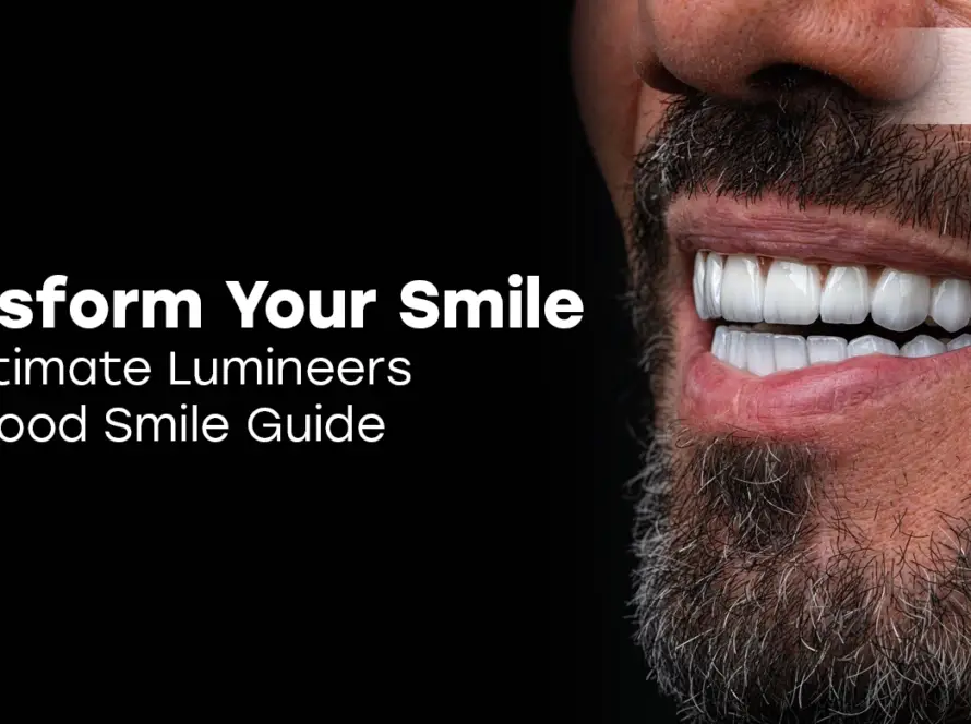 Lumineers Hollywood Smile: Ultra-Thin Veneers | VitrinClinic