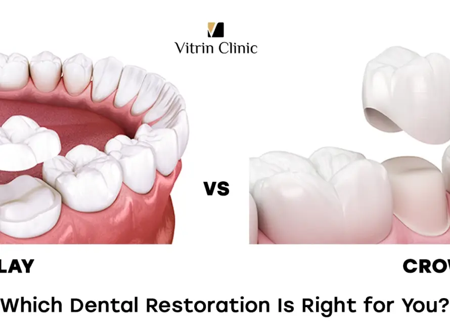 Onlay vs Crown: Which Dental Restoration Is Right for You?