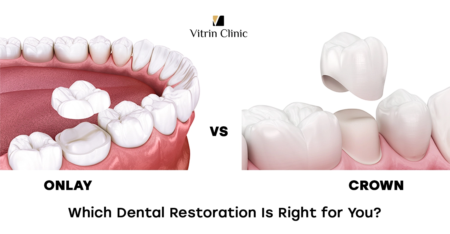 Onlay vs Crown: Which Dental Restoration Is Right for You?