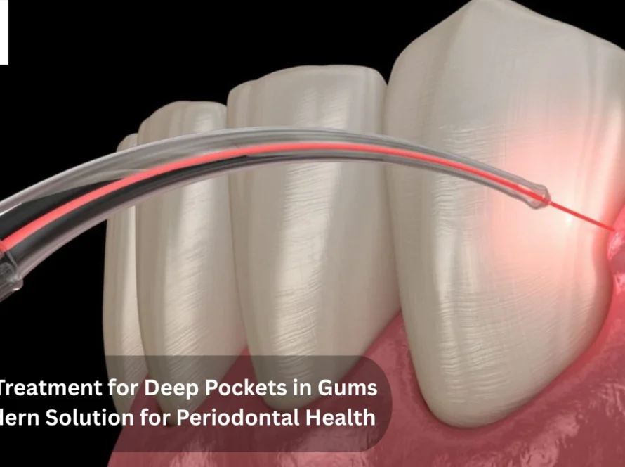 laser treatment for deep pockets in gums