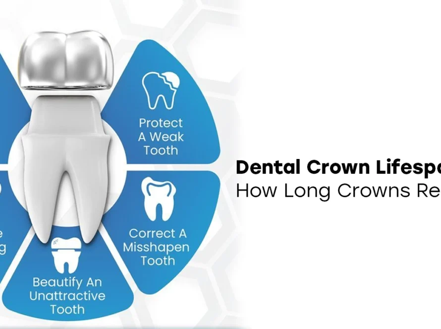 Dental Crown Lifespan