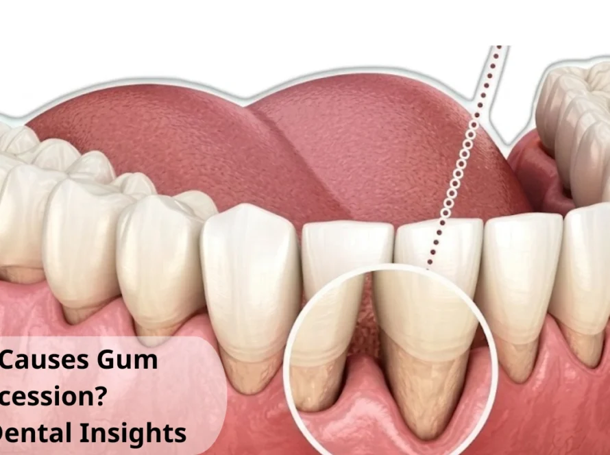 what causes gum recession