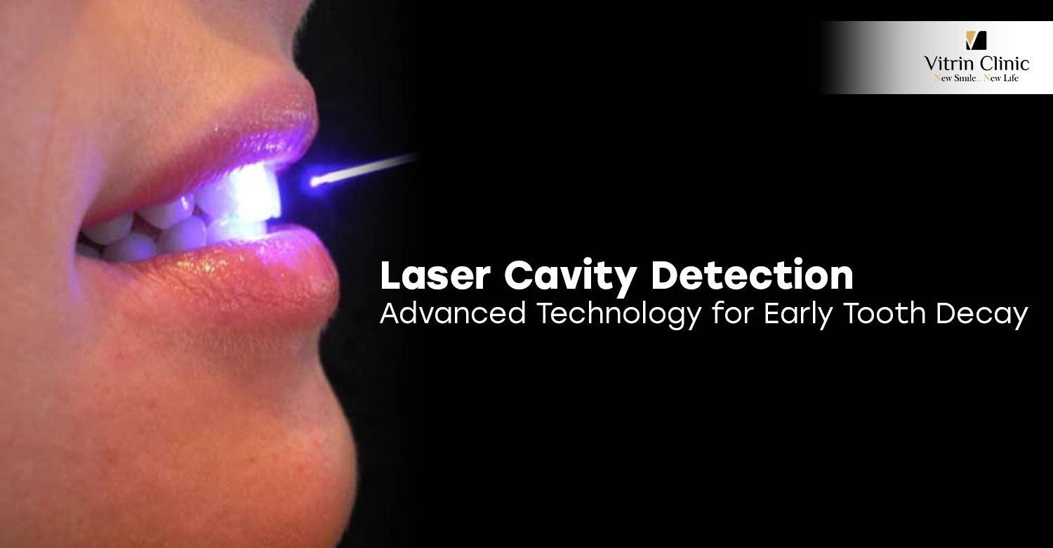 Laser Cavity Detection