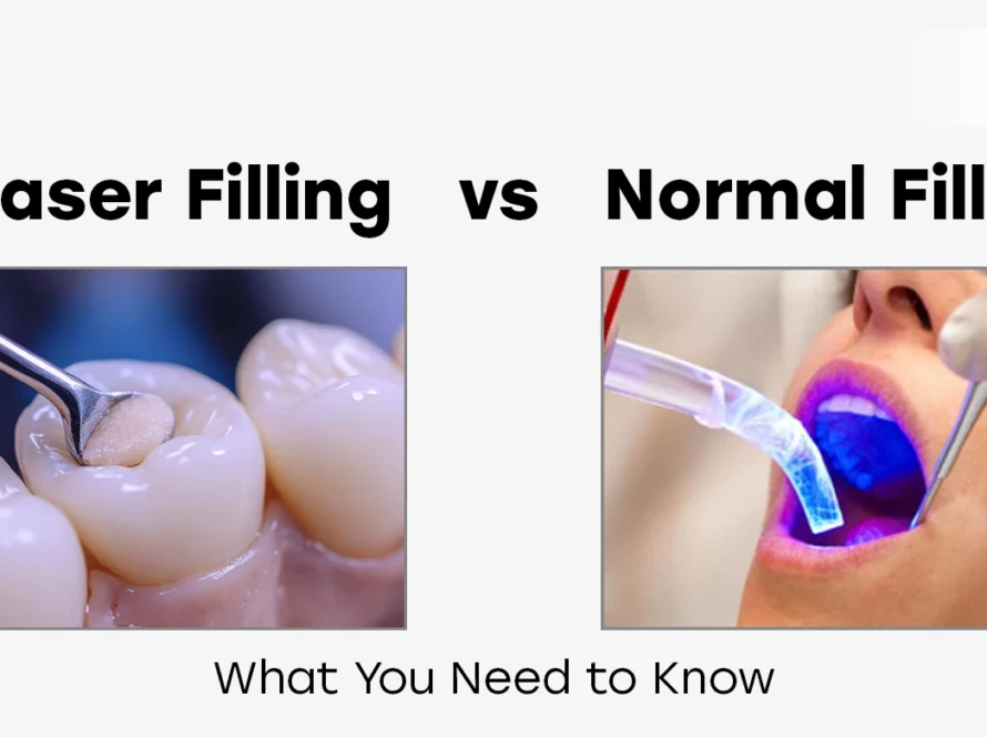 Laser Filling vs Normal Filling