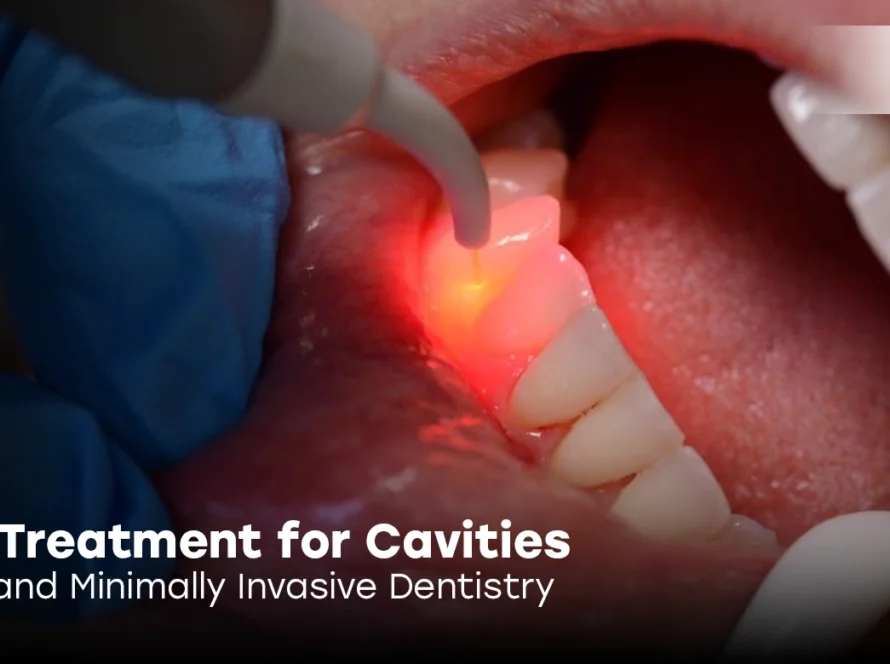 Laser Treatment for Cavities