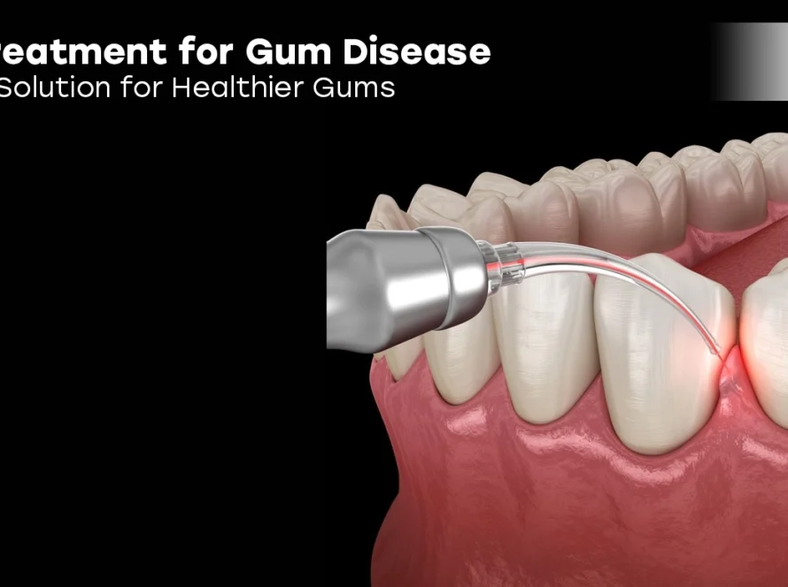 Laser Treatment for Gum Disease