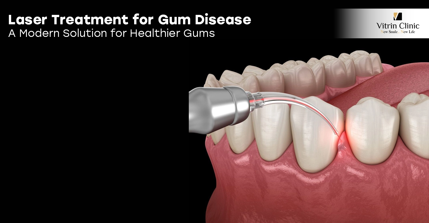 Laser Treatment for Gum Disease