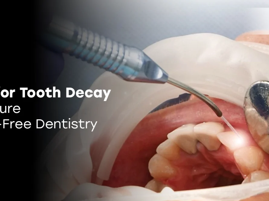 Laser for Tooth Decay